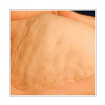 キャビテーション